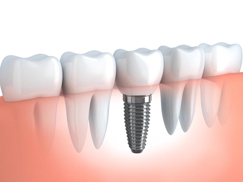 Dental Implants  Newark, CA 
